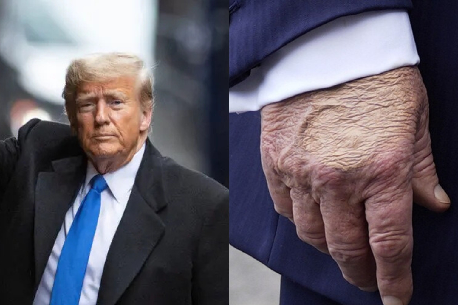 Trump Diagnosed with Chronic Venous Insufficiency